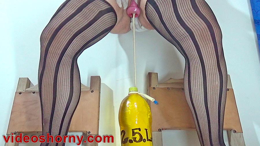 Cervix prolapsed with bottles hanging inside in prolapse uterus