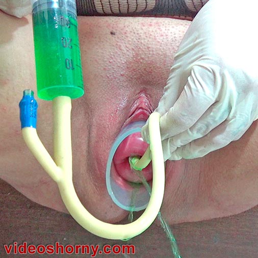 Cervix torture with the insertion of a catheter filled saline