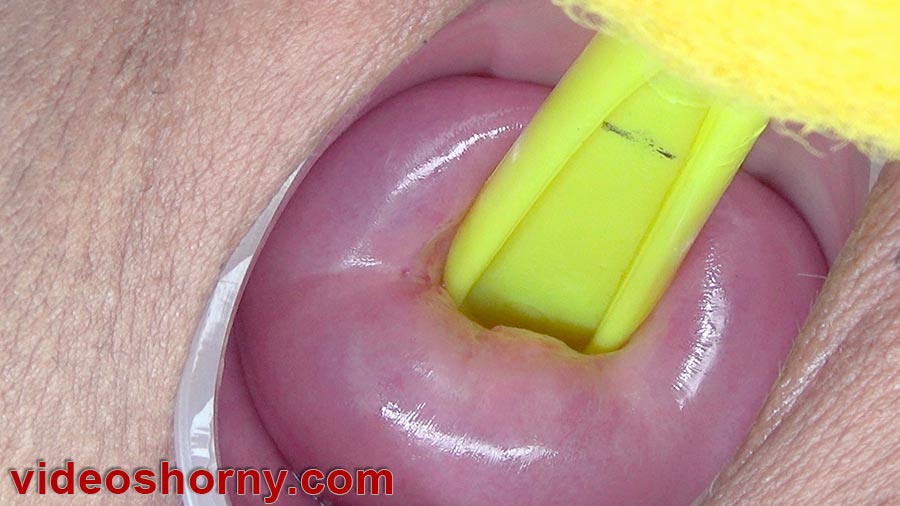 Handle of a 3 cm wide cleaning brush that she is able to turn inside the uterus