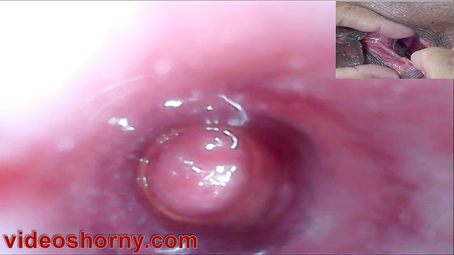 Endoscope camera into pee hole, watch inside urethra