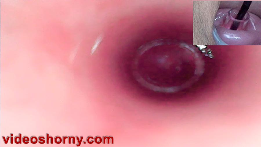 Endoscope camera into cervix, watch inside uterus