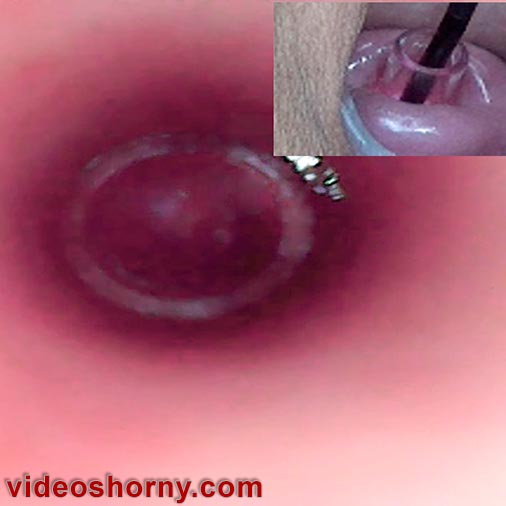 Blick in den Gebärmutterhals mit japanischer Endoskopkamera in die Gebärmutter